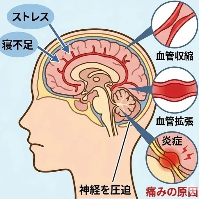 偏頭痛編