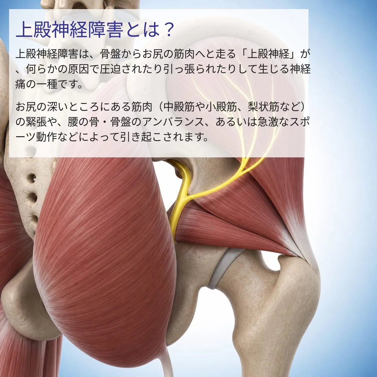 坐骨神経痛でお悩みの方へ。